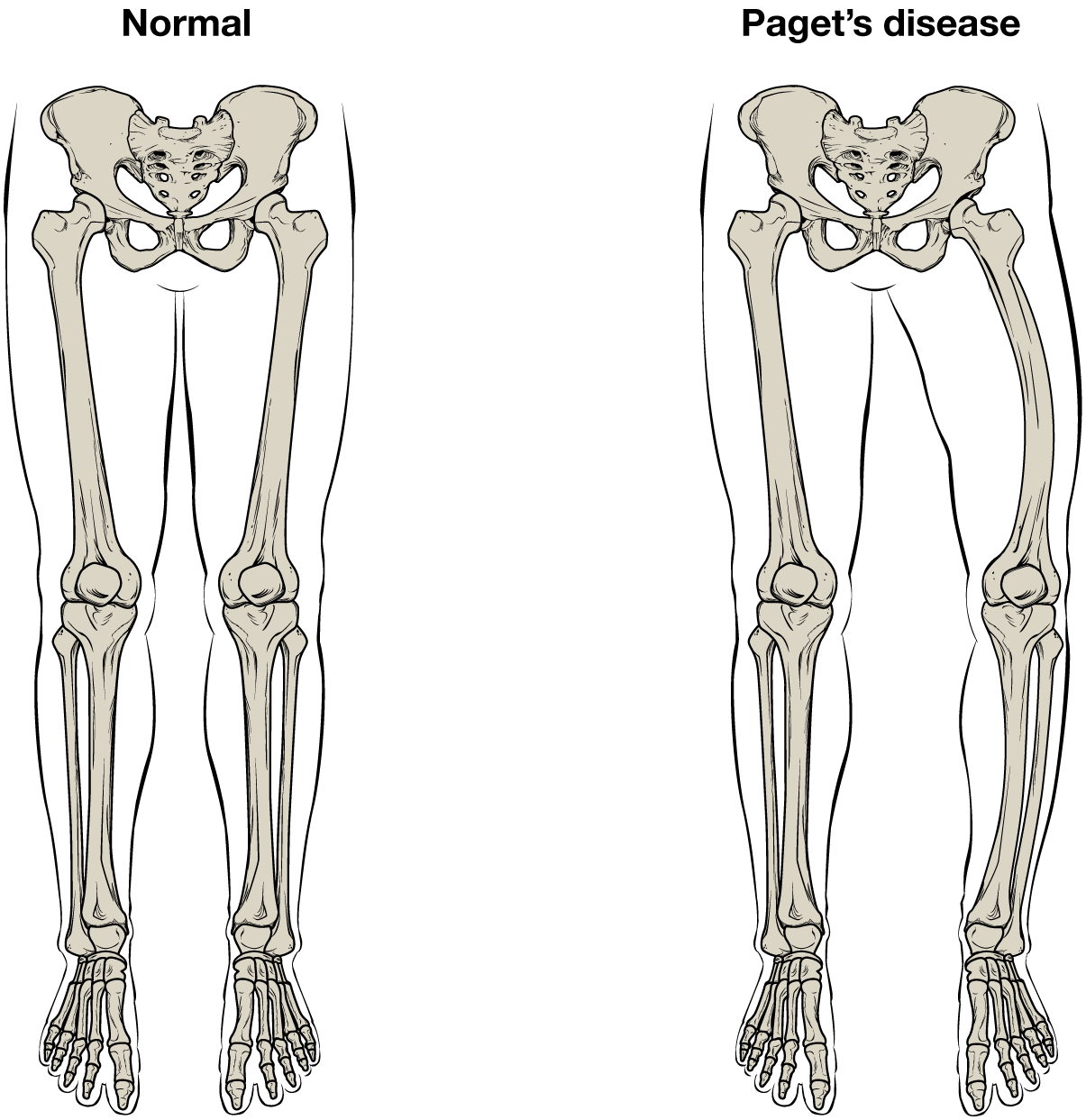 This illustration shows the normal skeletal structure of the legs from an anterior view. The flesh of the legs and feet are outlined around the skeleton for reference. A second illustration shows the legs of someone with Paget’s disease. The affected person’s left femur is curved outward, causing the left leg to be bowed and shorter than the right leg.
