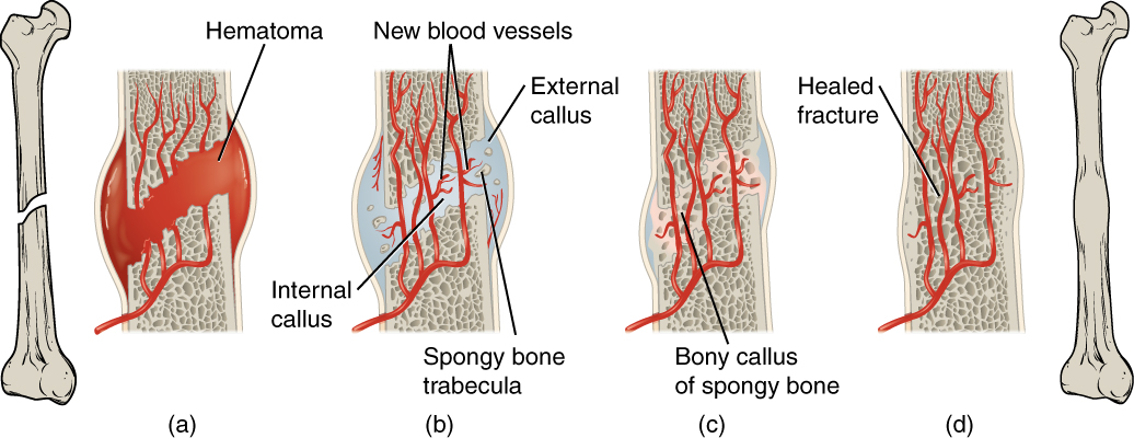 this-illustration-shows-a-left-to-right-progression-of-bone-repair-the