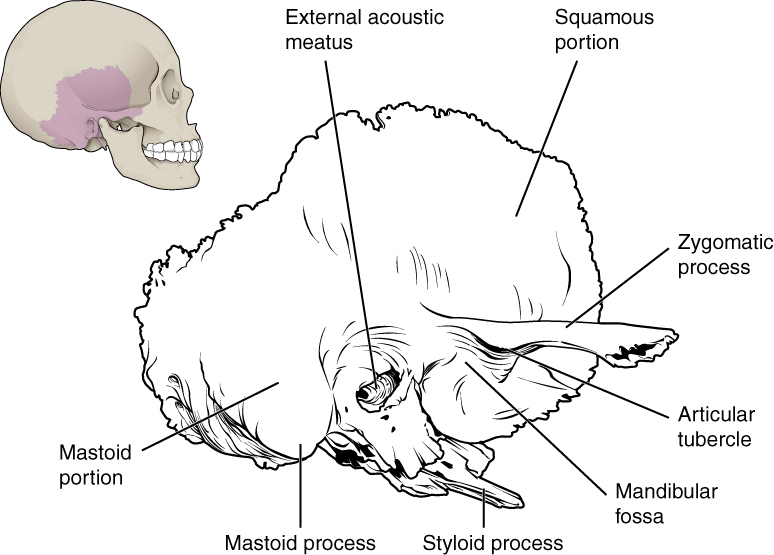 This image shows the location of the temporal bone. A small image of